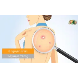 6 nguyên nhân gây mụn ở lưng mà bạn có thể chưa biết