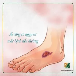 BỆNH TIỂU ĐƯỜNG LOẠI 2 CÓ THỂ CHỮA KHỎI