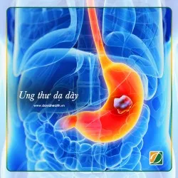 UNG THƯ DẠ DÀY VÌ CỒN VÀ THỊT CHẾ BIẾN SẴN