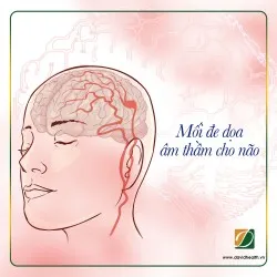 PHÌNH ĐỘNG MẠCH NÃO