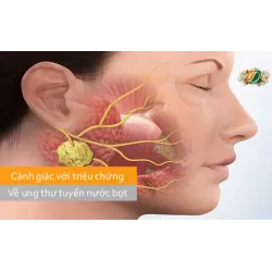 Cẩn thận với các triệu chứng bệnh ung thư tuyến nước bọt