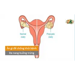 Phụ nữ bị mắc đa nang buồng trứng nên ăn gì để bệnh chóng khỏi, không lo vô sinh