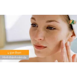 4 giai đoạn hình thành nám trên khuôn mặt của bạn