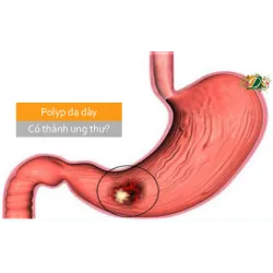 Polyp dạ dày có thành ung thư