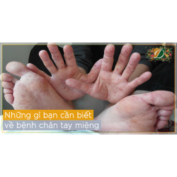 NHỮNG GÌ BẠN CẦN BIẾT VỀ BỆNH CHÂN TAY MIỆNG