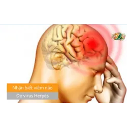 Nhận biết viêm não do virut herpes